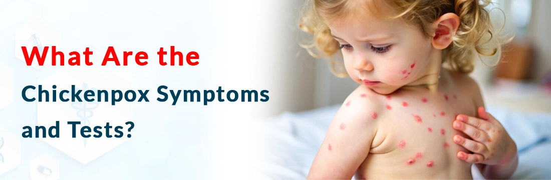 What Are the Chickenpox Symptoms and Tests?